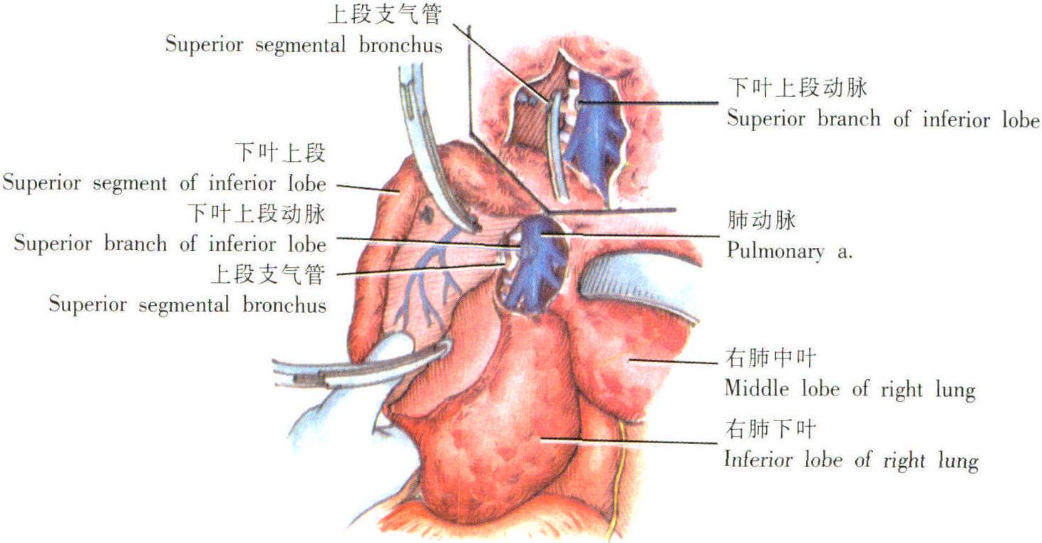 肺段切除術(shù)